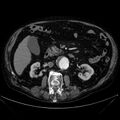 Abdominal aortic aneurysm (Radiopaedia 25855-26001 Axial C+ arterial phase 57).jpg