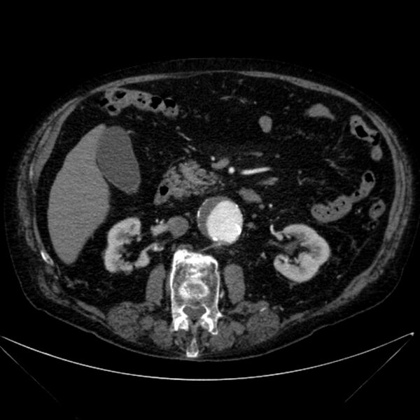 File:Abdominal aortic aneurysm (Radiopaedia 25855-26001 Axial C+ arterial phase 57).jpg