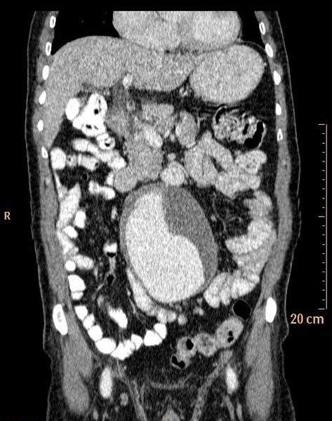 File:Abdominal aortic aneurysm (Radiopaedia 25985-26121 Coronal C+ arterial phase 11).jpg