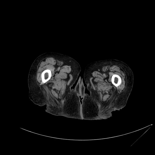 File:Abdominal aortic aneurysm - impending rupture (Radiopaedia 19233-19246 Axial non-contrast 148).jpg