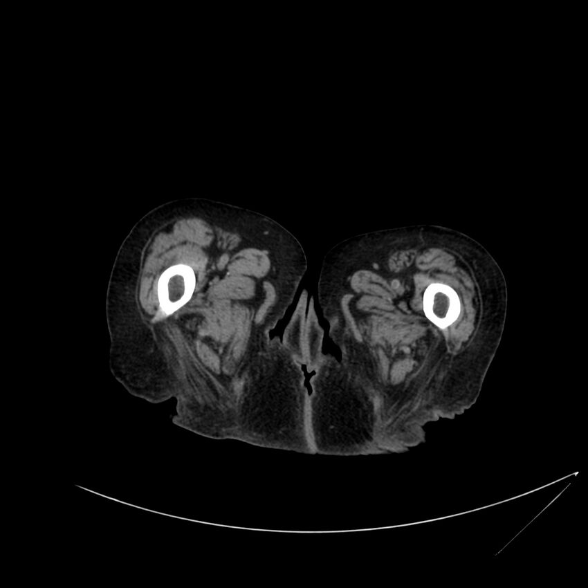 Abdominal aortic aneurysm - impending rupture (Radiopaedia 19233-19246 Axial non-contrast 148).jpg