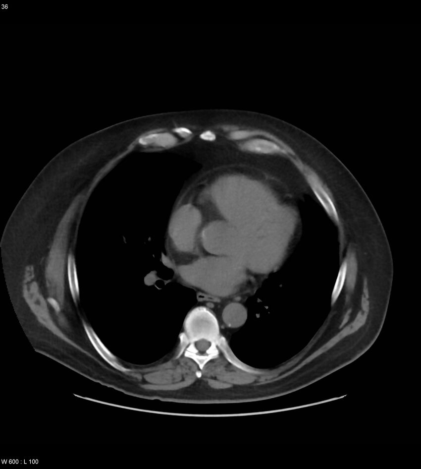 Abdominal aortic aneurysm with intramural hematoma then rupture (Radiopaedia 50278-55631 Axial non-contrast 32).jpg