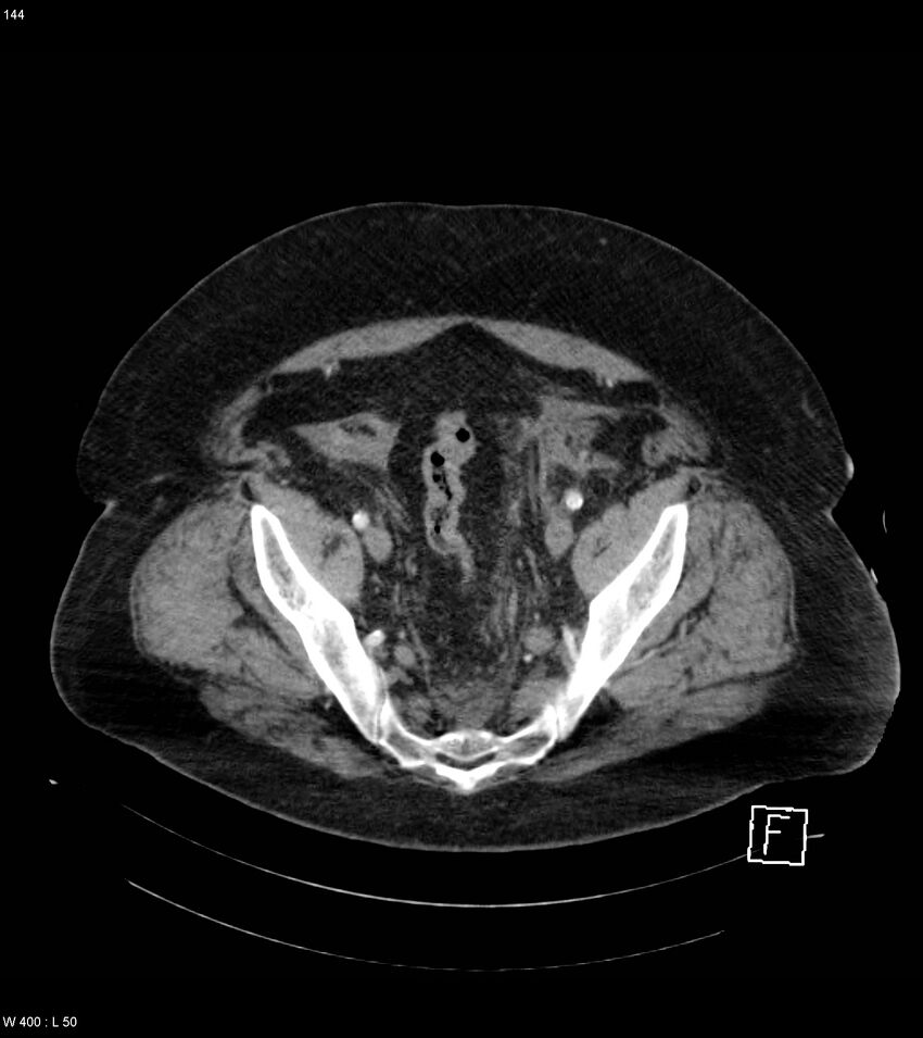 Abdominal aortic aneurysm with intramural hematoma then rupture (Radiopaedia 50278-55632 Axial C+ arterial phase 143).jpg