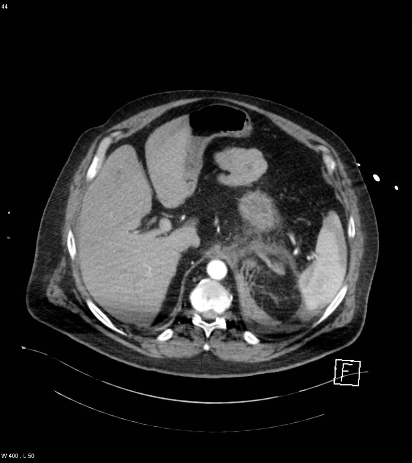 Abdominal aortic aneurysm with intramural hematoma then rupture (Radiopaedia 50278-55632 Axial C+ arterial phase 43).jpg