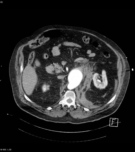File:Abdominal aortic aneurysm with intramural hematoma then rupture (Radiopaedia 50278-55632 Axial C+ arterial phase 62).jpg