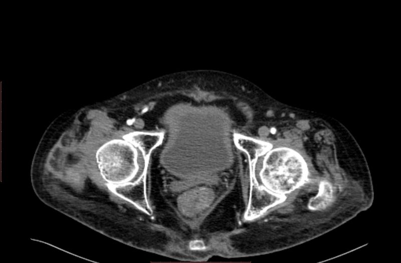 File:Abdominal aortic interposition tube graft and aneurysm thrombosis (Radiopaedia 71438-81857 Axial C+ arterial phase 231).jpg