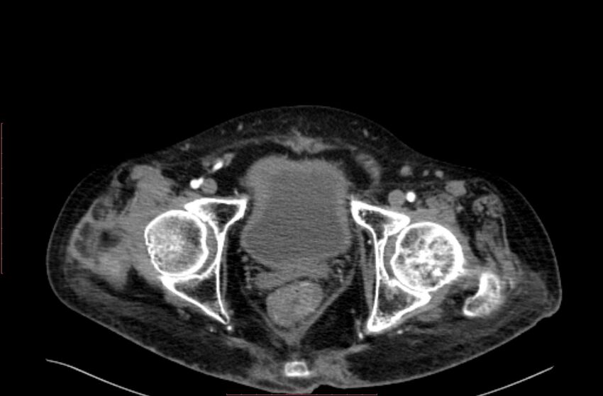 Abdominal aortic interposition tube graft and aneurysm thrombosis (Radiopaedia 71438-81857 Axial C+ arterial phase 231).jpg