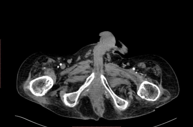 File:Abdominal aortic interposition tube graft and aneurysm thrombosis (Radiopaedia 71438-81857 Axial C+ arterial phase 267).jpg