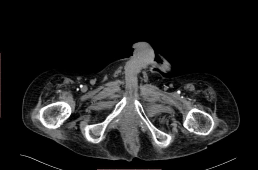 Abdominal aortic interposition tube graft and aneurysm thrombosis (Radiopaedia 71438-81857 Axial C+ arterial phase 267).jpg