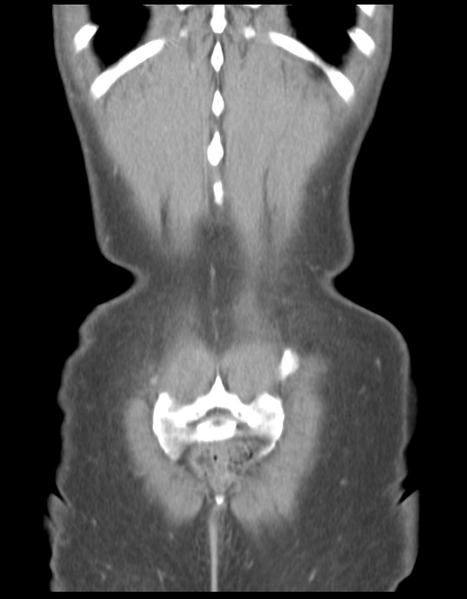 File:Abdominal desmoid tumor (Radiopaedia 41007-43740 Coronal C+ portal venous phase 38).png