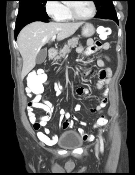 File:Abdominal wall metastasis from colorectal carcinoma (Radiopaedia 31016-31717 Coronal C+ portal venous phase 17).jpg