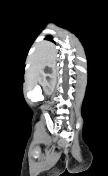 File:Abdominopelvic rhabdomyosarcoma (Radiopaedia 78356-90984 Coronal C+ portal venous phase 78).jpg