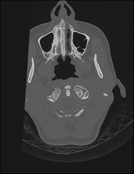 File:Aberrant right internal carotid artery (Radiopaedia 65191-74198 Axial non-contrast 3).jpg