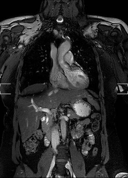 File:Aberrant right subclavian artery with background Takayasu arteritis (Radiopaedia 21423-21363 Coronal MRA 10).jpg