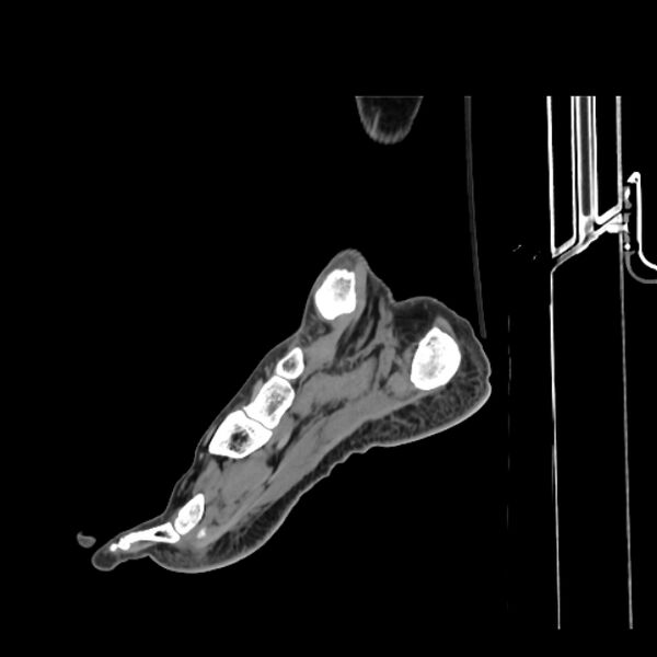 File:Accessory soleus muscle (Radiopaedia 61069-68943 Sagittal non-contrast 34).jpg