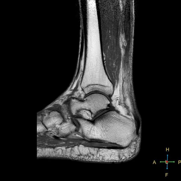 File:Achilles tendon complete tear (Radiopaedia 22834-22854 Sagittal T1 7).jpg