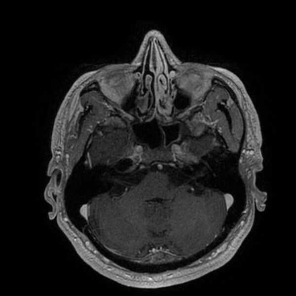 File:Acoustic schwannoma - intracanalicular (Radiopaedia 37247-39024 Axial T1 C+ 66).jpg
