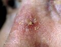 Actinic keratoses (DermNet NZ lesions-s-sk3).jpg