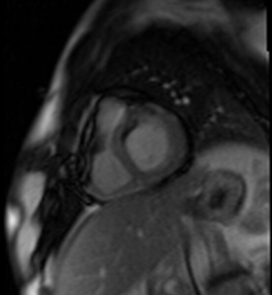 File:Acute anteroseptal myocardial infarction (Radiopaedia 68409-77945 Short axis (basal) Perfusion 26).jpg