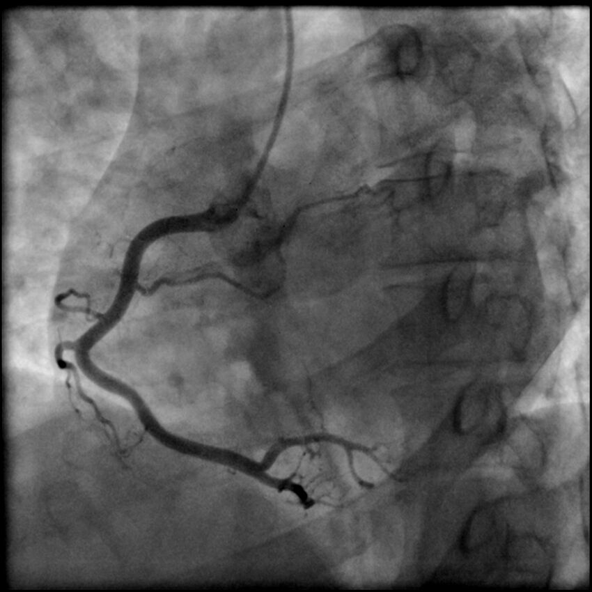 Acute anteroseptal myocardial infarction (Radiopaedia 68409-77946 RAO straight RCA 26).jpg
