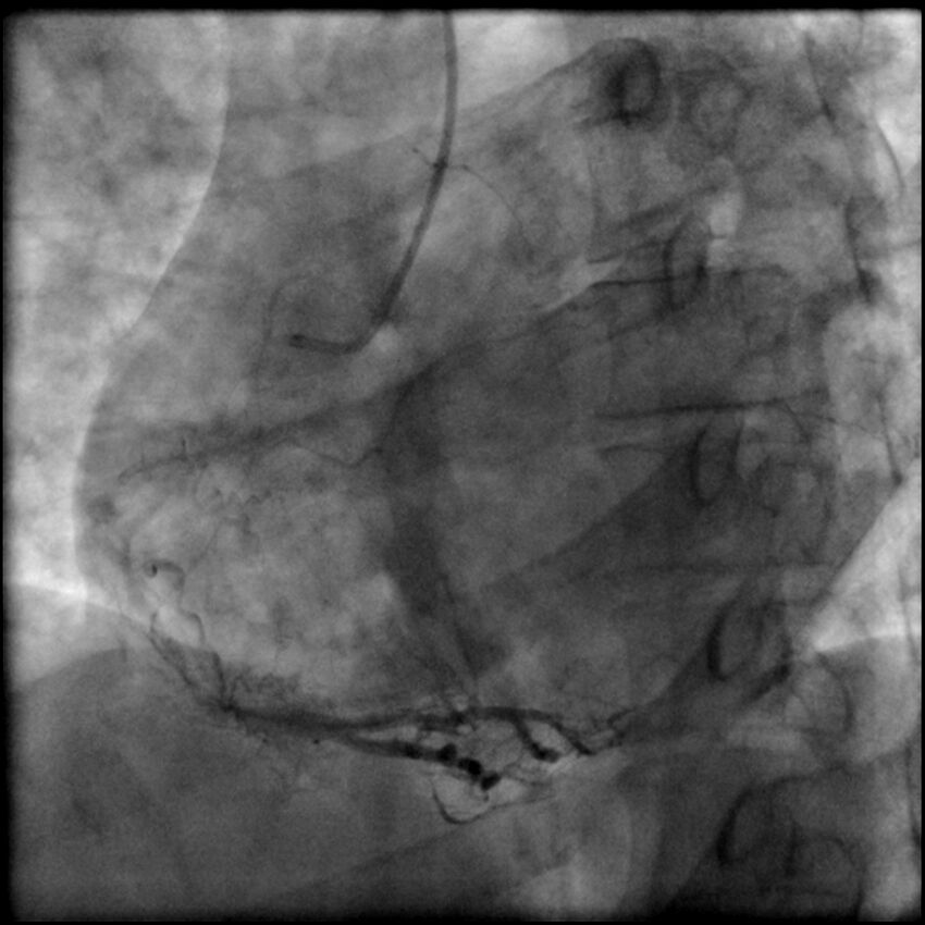 Acute anteroseptal myocardial infarction (Radiopaedia 68409-77946 RAO straight RCA 61).jpg