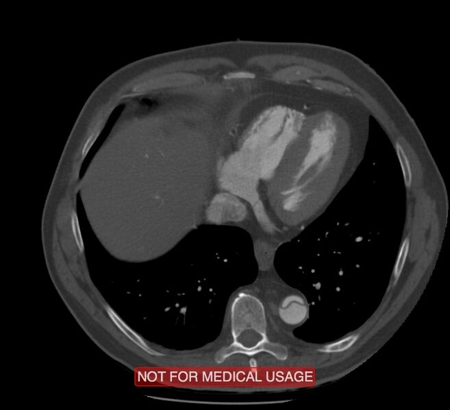 File:Acute aortic dissection - Stanford type A (Radiopaedia 40661-43285 Axial C+ arterial phase 55).jpg