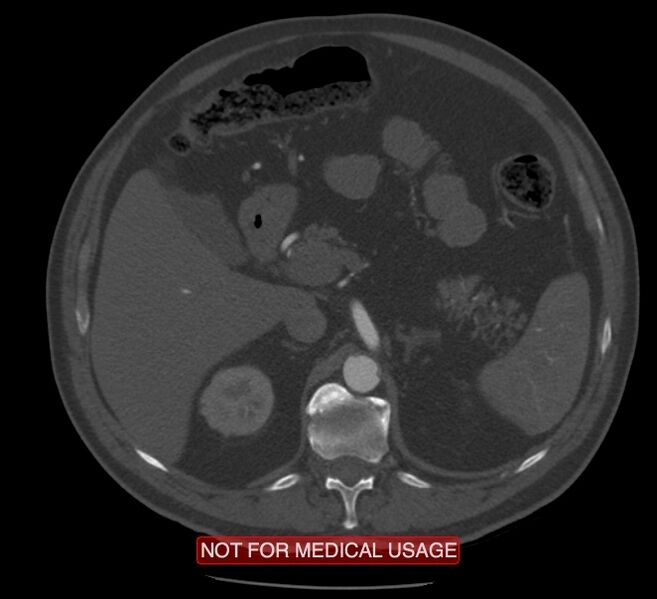 File:Acute aortic dissection - Stanford type A (Radiopaedia 40661-43285 Axial C+ arterial phase 92).jpg