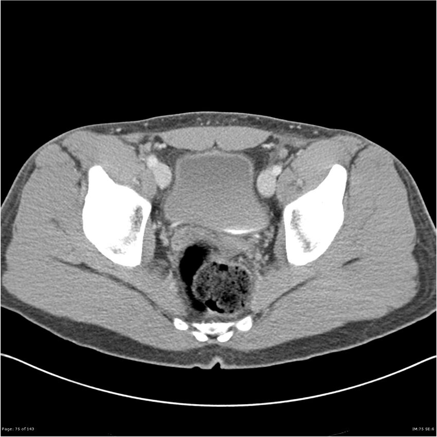 Acute appendicitis (Radiopaedia 25364-25615 B 65).jpg