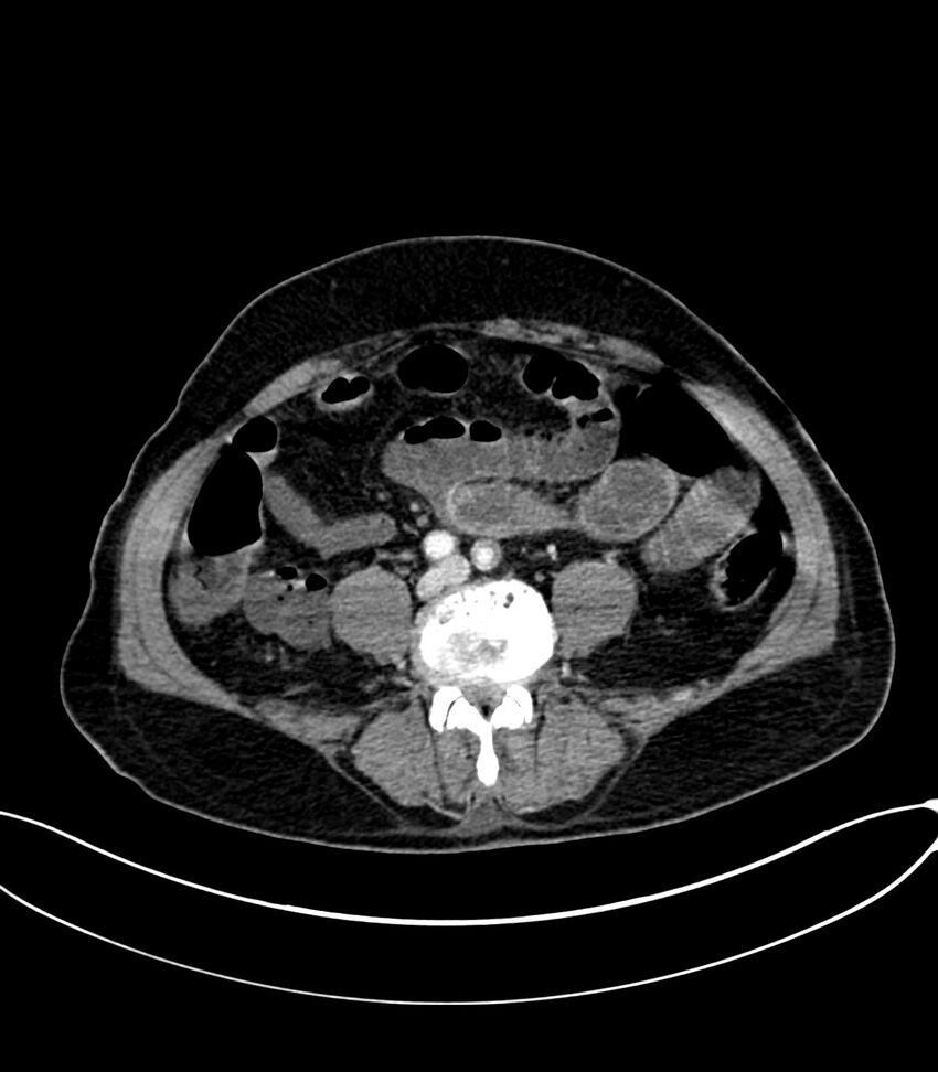 Acute arterial mesenteric ischemia (Radiopaedia 78238-90828 Axial C+ portal venous phase 89).jpg