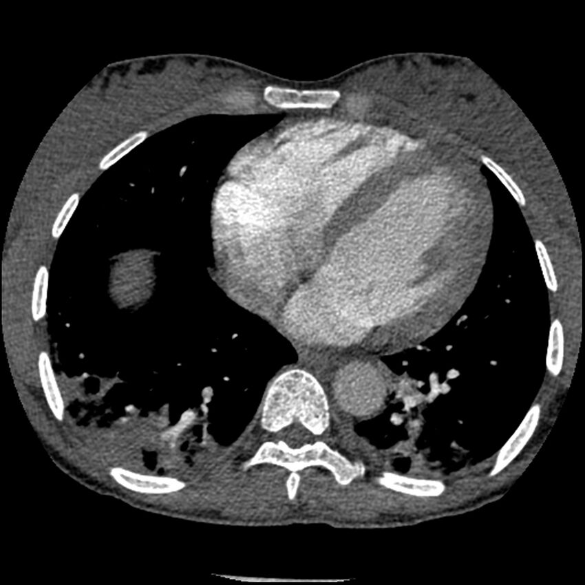 Acute chest syndrome - sickle cell disease (Radiopaedia 42375-45499 Axial C+ CTPA 131).jpg