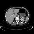 Acute myocardial infarction in CT (Radiopaedia 39947-42415 Axial C+ portal venous phase 34).jpg