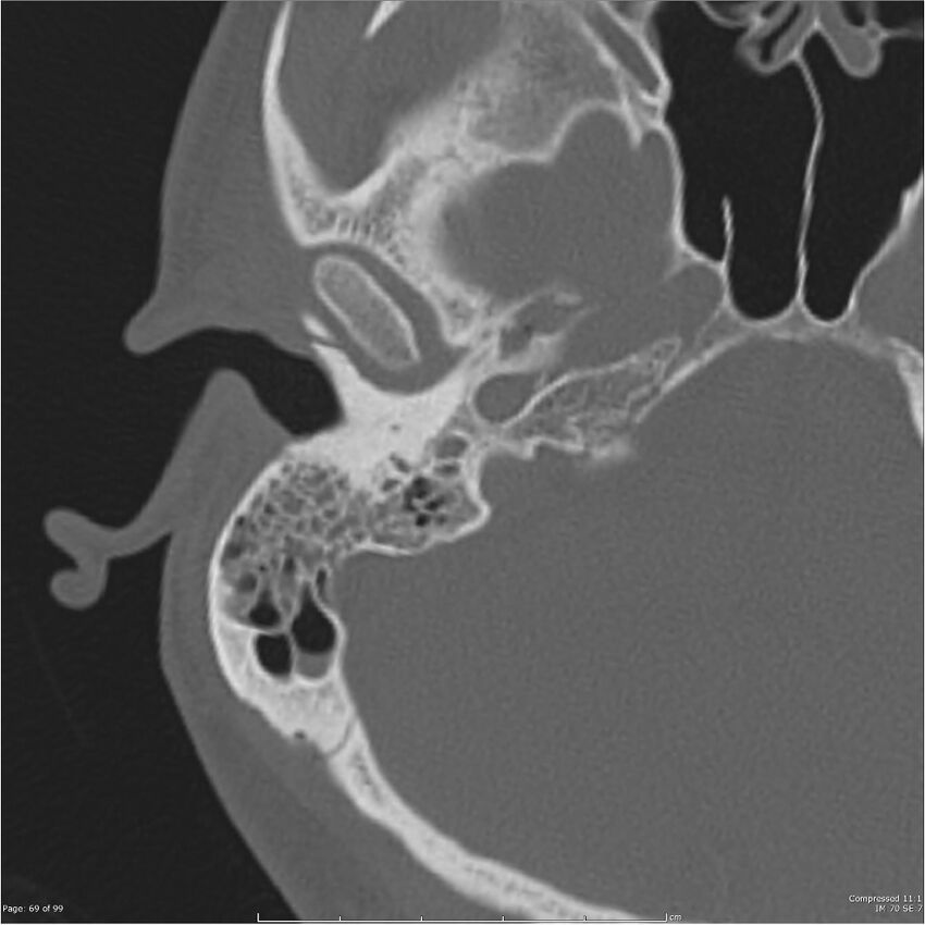 Acute otomastoiditis (Radiopaedia 28276-28512 Axial PTB bone window reformat 49).jpg