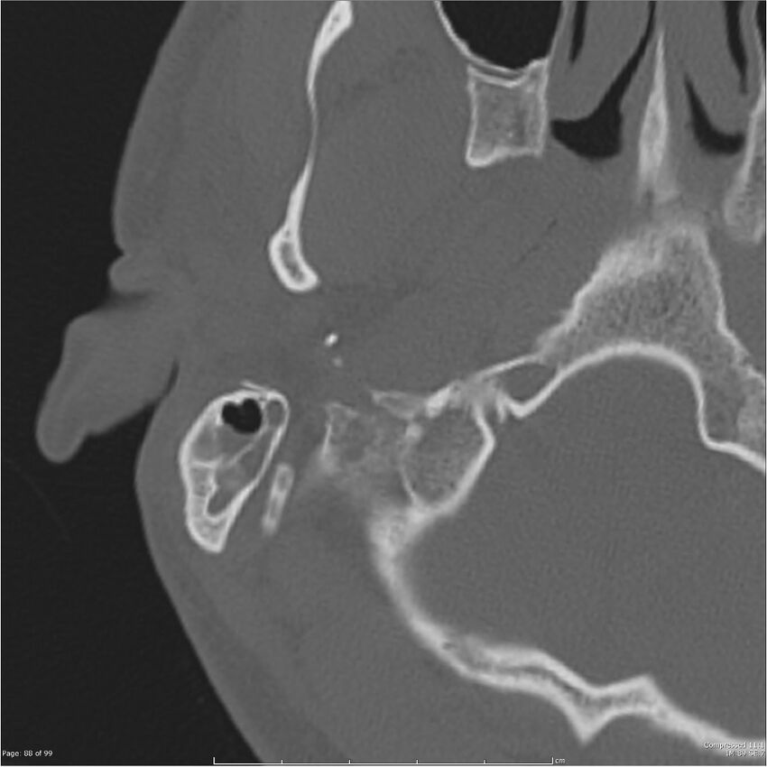 Acute otomastoiditis (Radiopaedia 28276-28512 Axial PTB bone window reformat 68).jpg