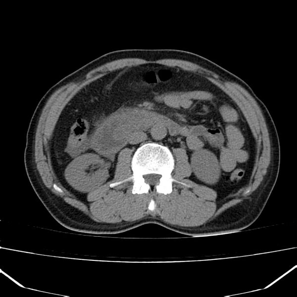 File:Acute pancreatitis (Radiopaedia 22572-22596 Axial non-contrast 30).jpg