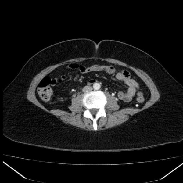 File:Acute pancreatitis - Balthazar C (Radiopaedia 26569-26714 Axial C+ arterial phase 54).jpg