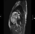 Acute perimyocarditis (Radiopaedia 48034-52833 Sagittal TRUFI CINE SHORT AXIS 44).JPG