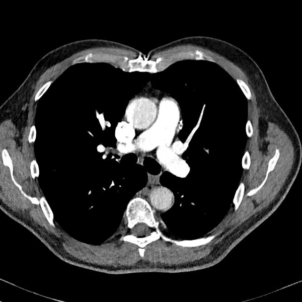 File:Acute pulmonary embolism (Radiopaedia 81677-95570 Axial C+ CTPA 36).jpg