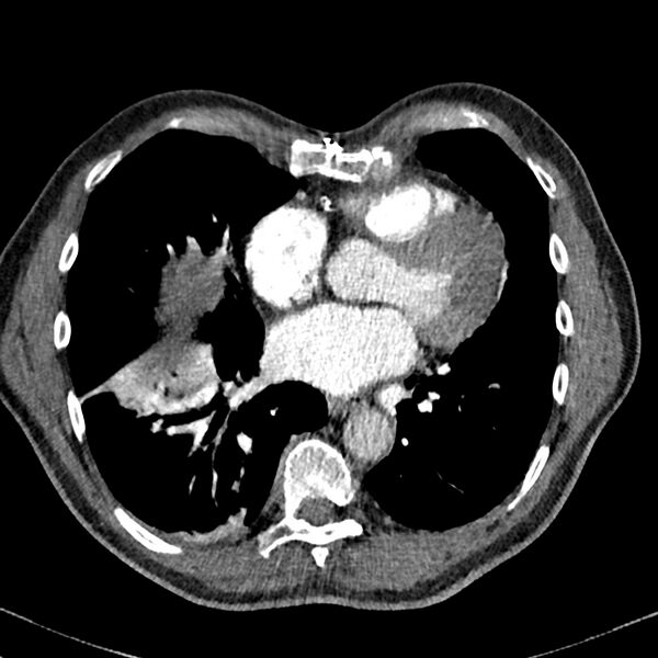 File:Acute pulmonary embolism (Radiopaedia 81677-95570 Axial C+ CTPA 74).jpg