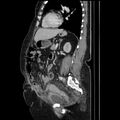 Acute pyelonephritis (Radiopaedia 25657-25837 Sagittal renal parenchymal phase 50).jpg