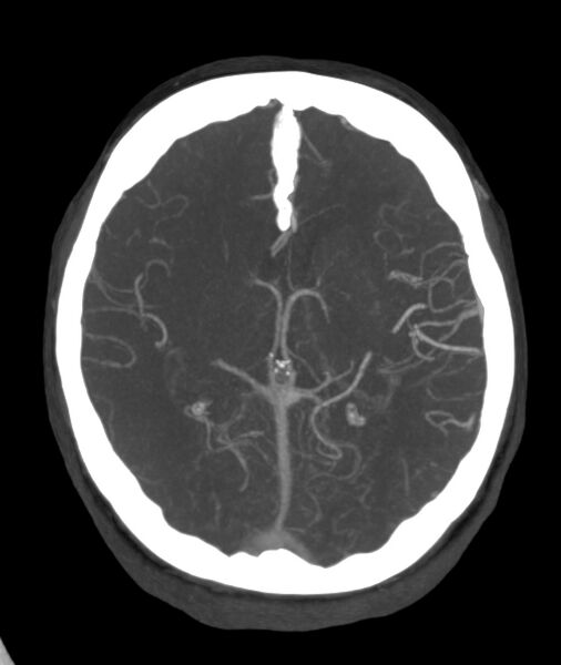 File:Acute right MCA M1 occlusion (Radiopaedia 62268-70454 Axial Phase 1 14).jpg