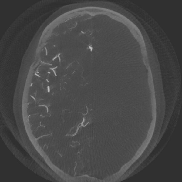 File:Acute subarachnoid hemorrhage and accessory anterior cerebral artery (Radiopaedia 69231-79010 Axial arterial - MIP 41).jpg