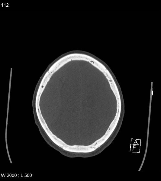 File:Acute subdural hematoma with myelofibrosis (Radiopaedia 52582-58494 Axial bone window 56).jpg