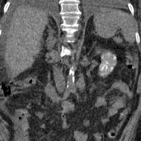 File:Acute tubular necrosis (Radiopaedia 28077-28334 Coronal non-contrast 6).jpg