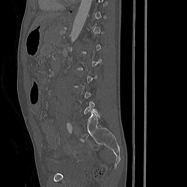 File:Acute vertebral body compression fractures (Radiopaedia 31757-32693 Sagittal bone window 13).jpg
