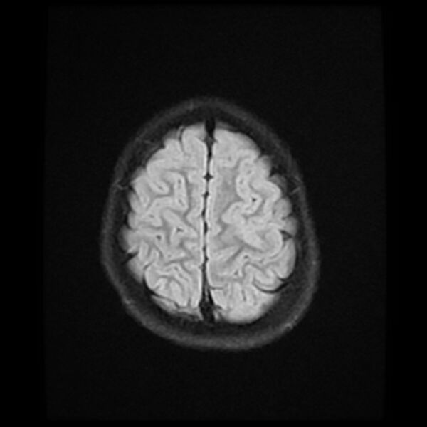 File:Adamantinomatous craniopharyngioma (Radiopaedia 77407-89529 Axial FLAIR 22).jpg
