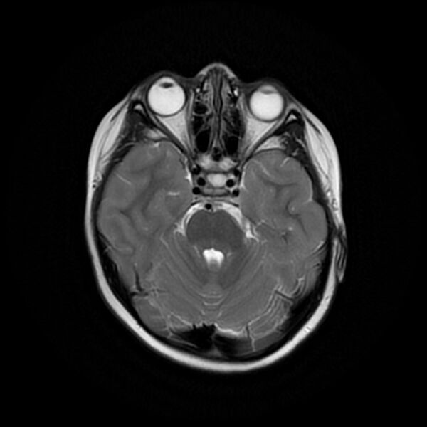 File:Adamantinomatous craniopharyngioma (Radiopaedia 77407-89529 Axial T2 8).jpg