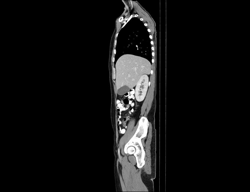 Addison disease (Radiopaedia 49318-54412 Sagittal C+ portal venous phase 50).jpg