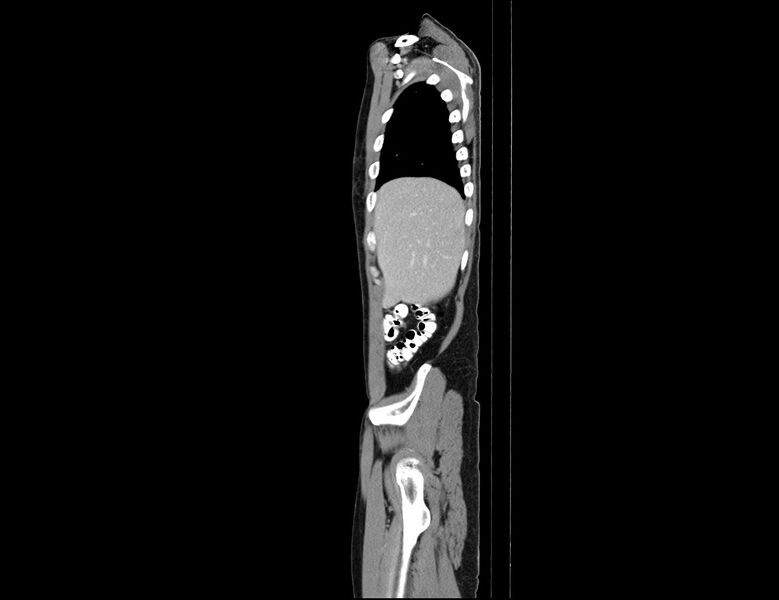 File:Addison disease (Radiopaedia 49318-54412 Sagittal C+ portal venous phase 59).jpg