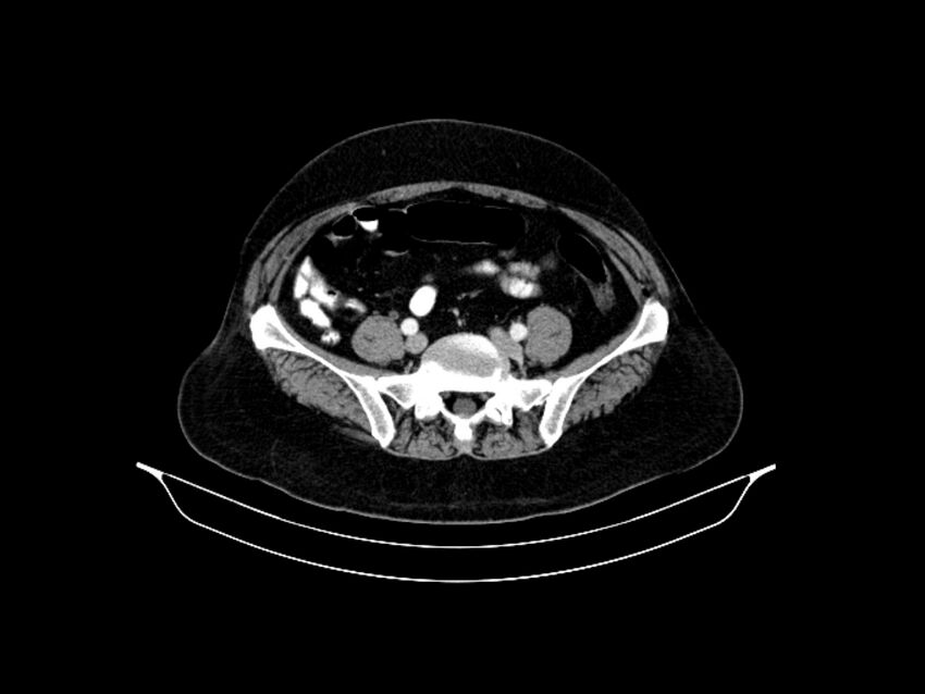 Adenocarcinoma of pancreas with hepatic metastasis (Radiopaedia 64332-73122 Axial C+ portal venous phase 74).jpg