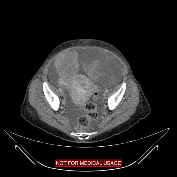 File:Adenocarcinoma of the cervix (Radiopaedia 28373-28616 Axial C+ portal venous phase 18).jpg